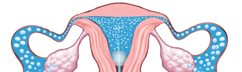 Uterine Evaluation A Femvue or Hysterosalpingogram (HSG) is a procedure performed to determine whether the fallopian tubes are open and to see if the shape of the uterine cavity is normal.