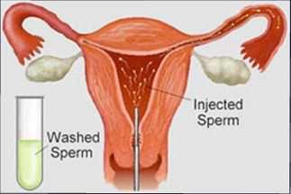 Ovulation Induction with Intrauterine Insemination (IUI) Clomiphene or Letrozole (oral medications that help treat irregular or absent ovulation) are often the first-line therapy for many women.