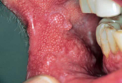 It is less common Clinical Features Site: buccal mucosa, tongue, floor of the