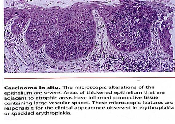 Def. Carcinoma in situ is defined as dysplastic epithelial cells that extend from the basal layer to the surface of the mucosa " top to bottom" change. Histopathology 1.