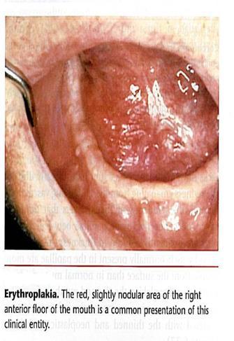 Erythroplakia Def. Red - patch that cannot be clinically or pathologically diagnosed as any other condition Etiology Clinical features 1.Unknown 2.epithelial dysplasia 3.