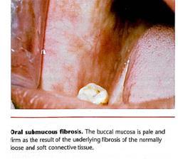 Oral submucous fibrosis Def.