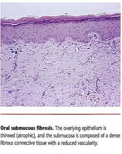 high-risk precancerous condition of the oral mucosa seen primarily on the Indian and in South East Asia. Etiology Clinical features Histopathology 1. tobacco 2. betel nut quids 3.