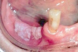 Chronic hyperplastic candidosis (candidal leukoplakia) A clinical form of C.