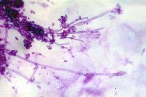 They cannot be removed by scraping,but fragments may be detached & identification of hyphae in smears of such material assists in the diagnosis. 3.