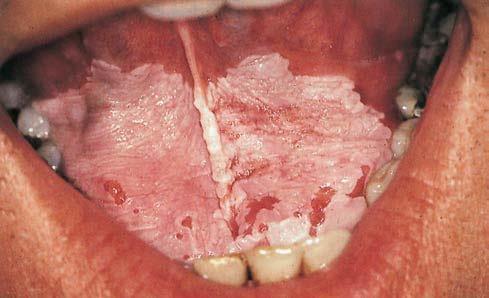 buccal mucosa