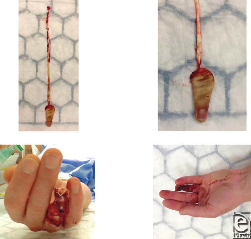 Interesting Case Series Ring Avulsion Injuries Matt Jones BMBS, BSc, MRCS, and Sameer Gujral MBChB, BSc, MRCS Department of Plastic Surgery,