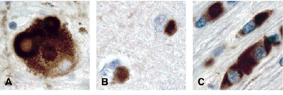 α-synuclein a-synuclein is the major filamentous component of: Lewy Bodies (PD, LBD) and Glial Cytoplasmic Inclusions (MSA) Idiopathic Parkinson's