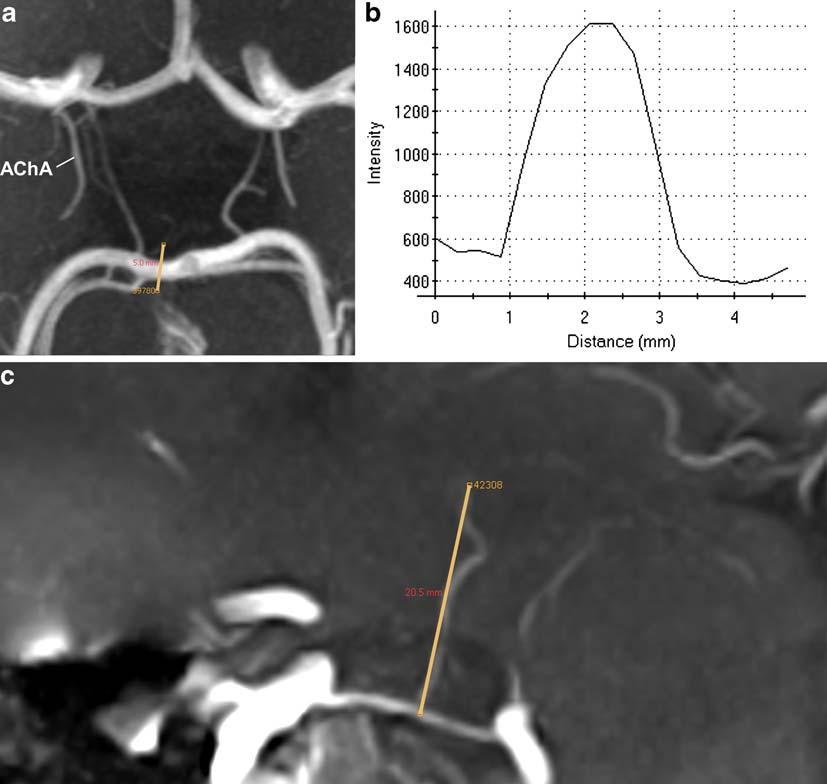2988 Fig. 1 a Time-of-flight angiography image of the circle of Willis and the anterior choroidal artery (AChA) on 7.0-Tesla MRI, transverse slab maximum intensity projection (thickness 7 mm).