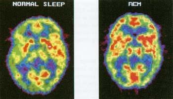 REM Sleep A stage of sleep characterized by rapid eye movements, a high level of brain activity, a deep relaxation of the muscles, and dreaming Known as active sleep as