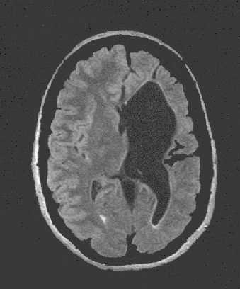 HYPOTHETICAL CASE: Stroke & Seizure A 65 year-old man had a left middle
