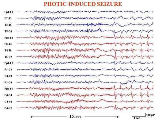 HYPOTHETICAL CASE: Photic Seizure A 6 year-old boy has had 2 seizures 3 days apart while playing a videogame