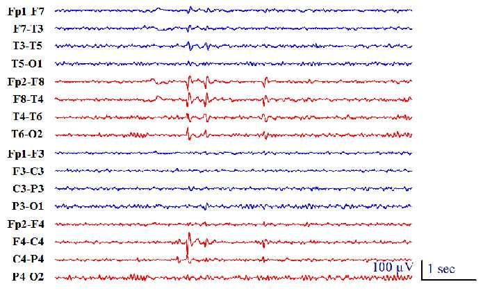 Benign Epilepsy with Centro-Temporal Spikes (BECTS) A 25 year-old man had seizures with face twitching when