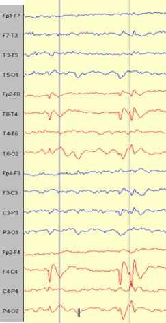 Benign Epilepsy with Centro-Temporal Spikes (BECTS) A 25 year-old man had seizures with face twitching when falling asleep at ages 9, 10 and 11 years; none since.