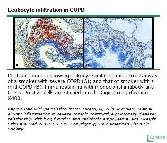 Leukocyte Infiltration in COPD Smoker, Severe COPD Smoker, Mild COPD COPD highly prevalent, underdiagnosed, undertreated, and underperceived Immunostaining with monoclonal antibody anti-cd45 COPD