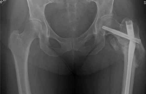 of the proximal femur. In many instances today, IM nailing is the treatment of choice for subtrochanteric fractures.