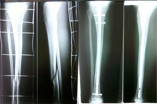 Figure 6 All patients with tibial shaft fracture achieved union during 12-28 weeks (mean: 13.