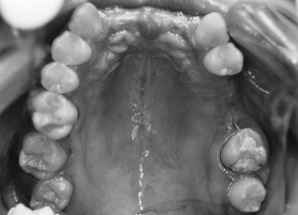 Figure 1 Preoperative occlusal view of missing teeth: maxillary incisors, left second premolar, and left first molar.