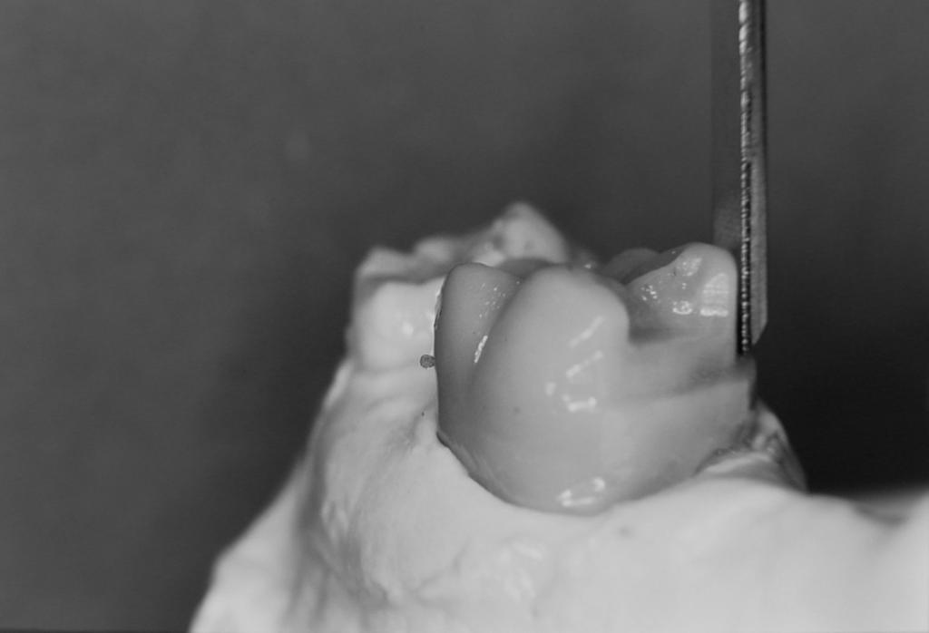The surveyor blade was used to locate proximal undercuts on the anterior abutments (Fig 2A). The retentive area on the distobuccal surface of tooth #2 was determined using the conventional 0.