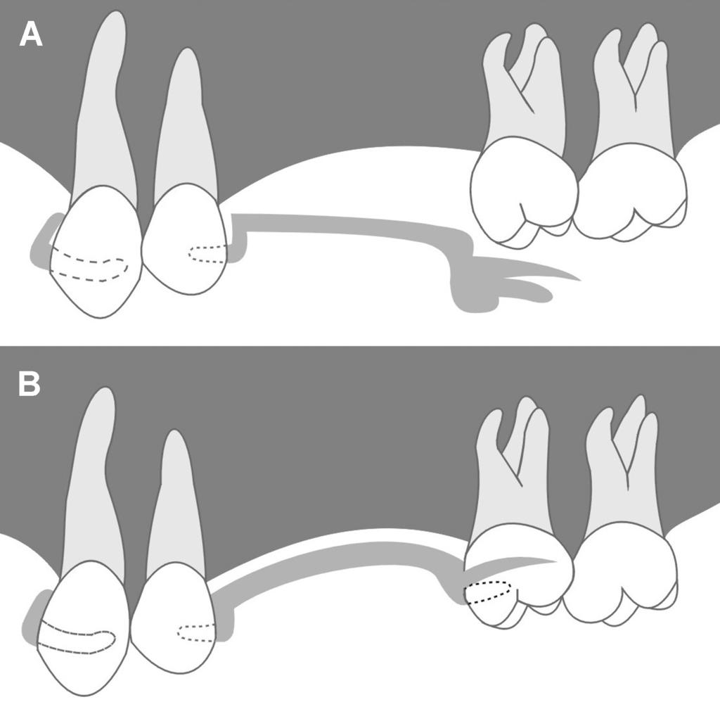 Figure 6 Minor connectors in intimate contact with undercut areas.