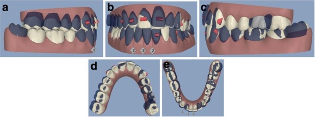 Mampieri and Giancotti Progress in Orthodontics 2013, 14:40 Page 3 of 9 Figure 3 ClinCheck* pre-post superimposition (a to e). cooperation in wearing each aligner for 2 weeks as planned.