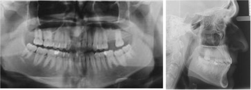 Mampieri and Giancotti Progress in Orthodontics 2013, 14:40 Page 4 of 9 Figure 5 Post-treatment radiographs. On the right side, the relationship of Class III was not corrected.