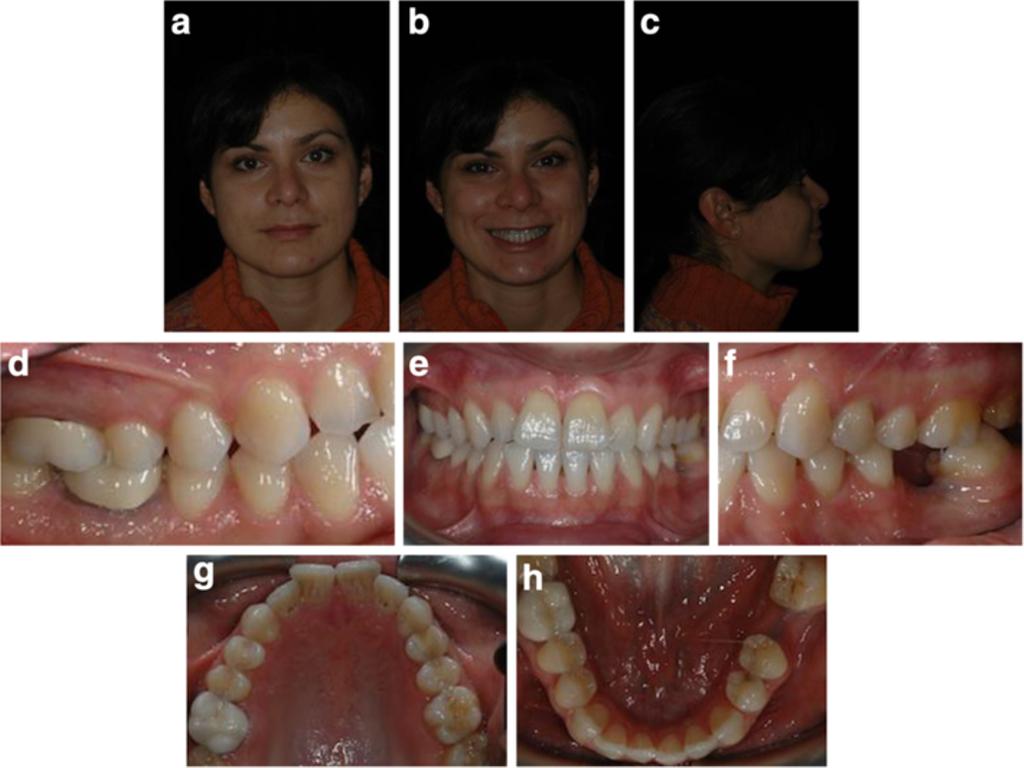 3.7 to gain space for the implant arch to gain space enough for implant placement and obtaining a good overjet and overbite (Figure 8a,b,c,d,e).