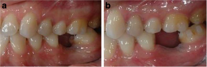 Mampieri and Giancotti Progress in Orthodontics 2013, 14:40 Page 6 of 9 Figure 10 Molar uprighting (a and b). The uprighting of 3.7 was obtained, with a good vertical control.
