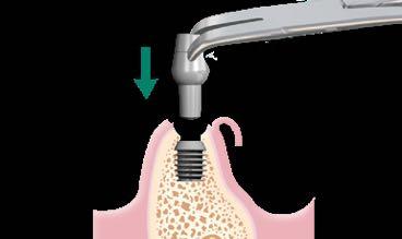 connection, then tap on abutment in long axis of abutment post to engage locking taper.