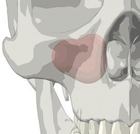Submandibular Fossa Care must be taken to avoid the penetration of the submandibular fossa which is located below the mylohyoid line, and particularly the sublingual space in the