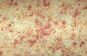 Petechiae (typical of