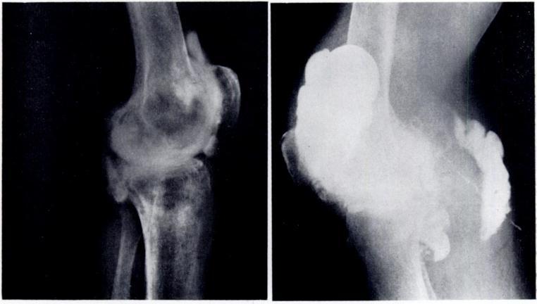 TREATMENT OF THE POPLITEAL CYST IN THE RHEUMATOID KNEE 121 discharging sinus in the popliteal space over a period of five months.