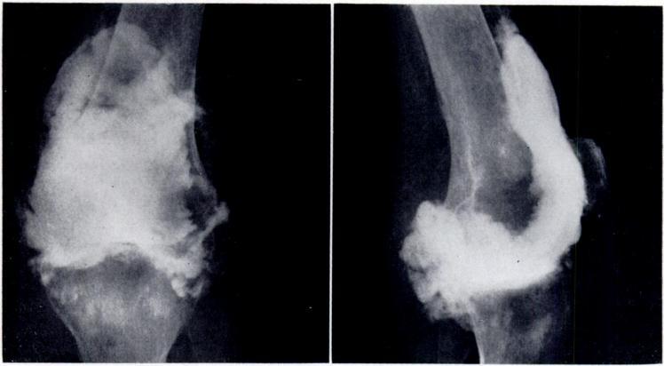 The sinus and cyst were excised from the left knee and a month later anterior synovectomy was done on the right knee.
