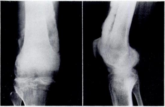 Case 10-A forty-four-year-old man, a school teacher, with sero-positive rheumatoid arthritis of three years duration complained of a painful swollen right knee associated with a popliteal cyst for