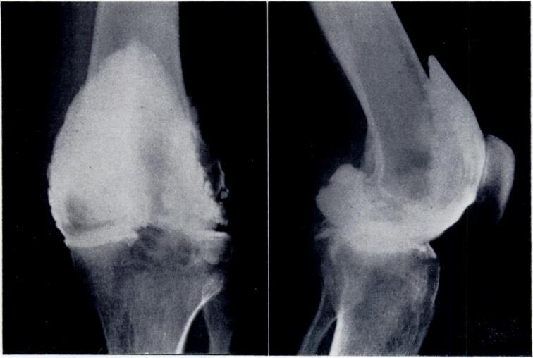 TREATMENT OF THE POPLITEAL CYST IN THE RHEUMATOID KNEE 123 DISCUSSION Wilson, Eyre-Brook and Francis (1938) postulated that a chronic knee effusion with raised