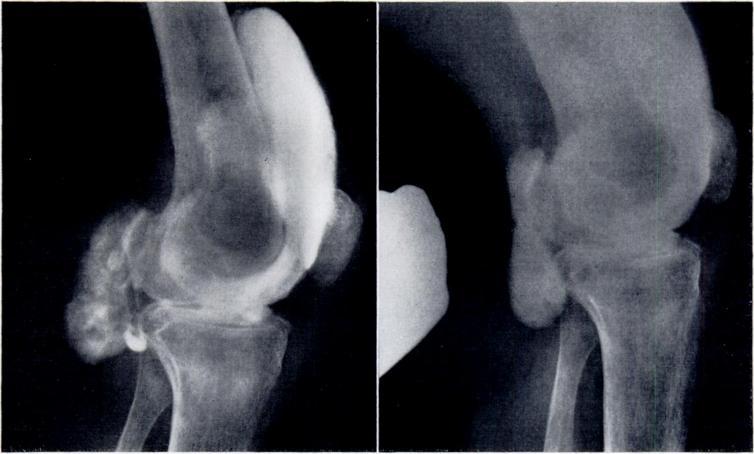 9 FIG. 10 Case I 3-Arthrograph showing how pressure on the popliteal fossa causes a flow of fluid back into the knee joint. popliteal fossa. They suggested that a flap valve mechanism was operative in one of their cases.