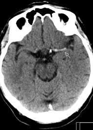 Case 1 64 year old female with dysphasia and right arm weakness 3 hours prior CT head: dense M1 sign.