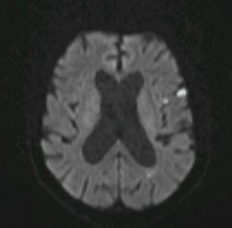 Case 3: 51 year old male with expressive dysphasia PMH: None. No regular medications.
