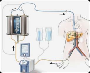 Extracorporeal Filtration