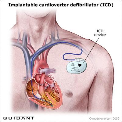 ICD Indications Generally Used in cases where there was a previous cardiac arrest Or,
