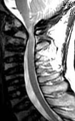 Complication: Slight mental retardation Radiology: C1/2 stenosis (+) Hypoplasia of odontoid