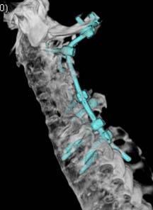 whole spine (+) Micro instability at C1/2 was suspicious Surgical Procedure: C1-3 decompression &