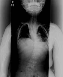 thoracolumbar spine into kyphoscoliosis during