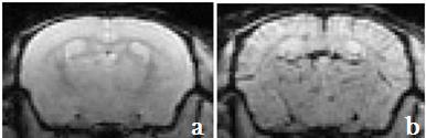 ΔR2* hippocampus/total rcbv brain Cerebral Blood Volume Before USPIO After USPIO