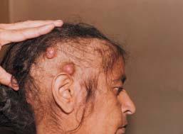 This could account for the difference in observations. The scalp formed an unusual site for cutaneous metastasis in a case of carcinoma rectum (Figures 3-4).