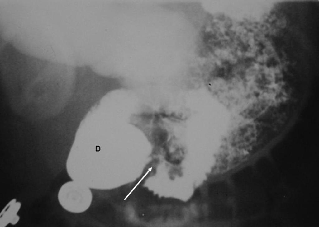 Fig. 12: Duodenal Atresia: Markedly distended stomach and duodenum - Double bubble sign. No gas seen in rest of the small bowel or large bowel. Fig.