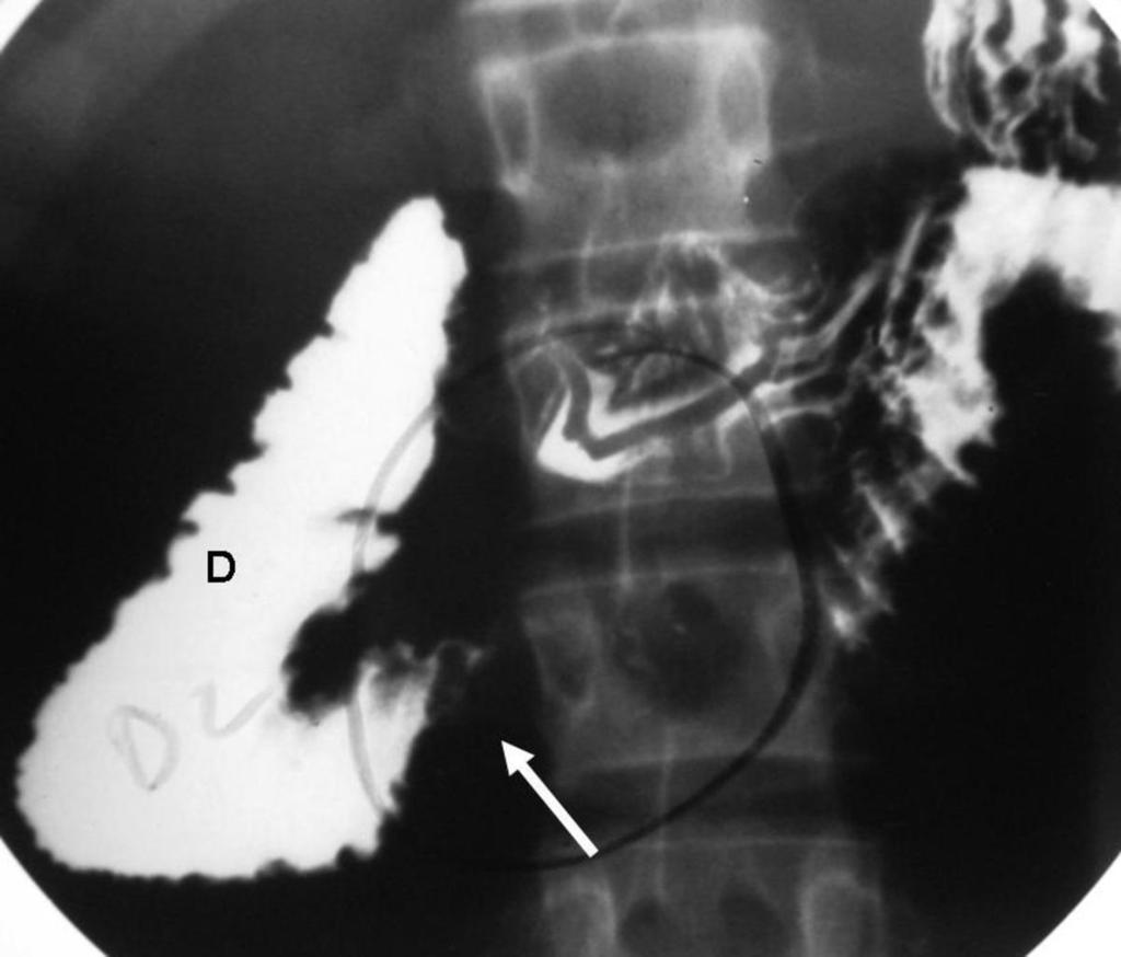 Fig. 14: SMA sydrome: Note the dilated duodenum (D) with abrupt calibre