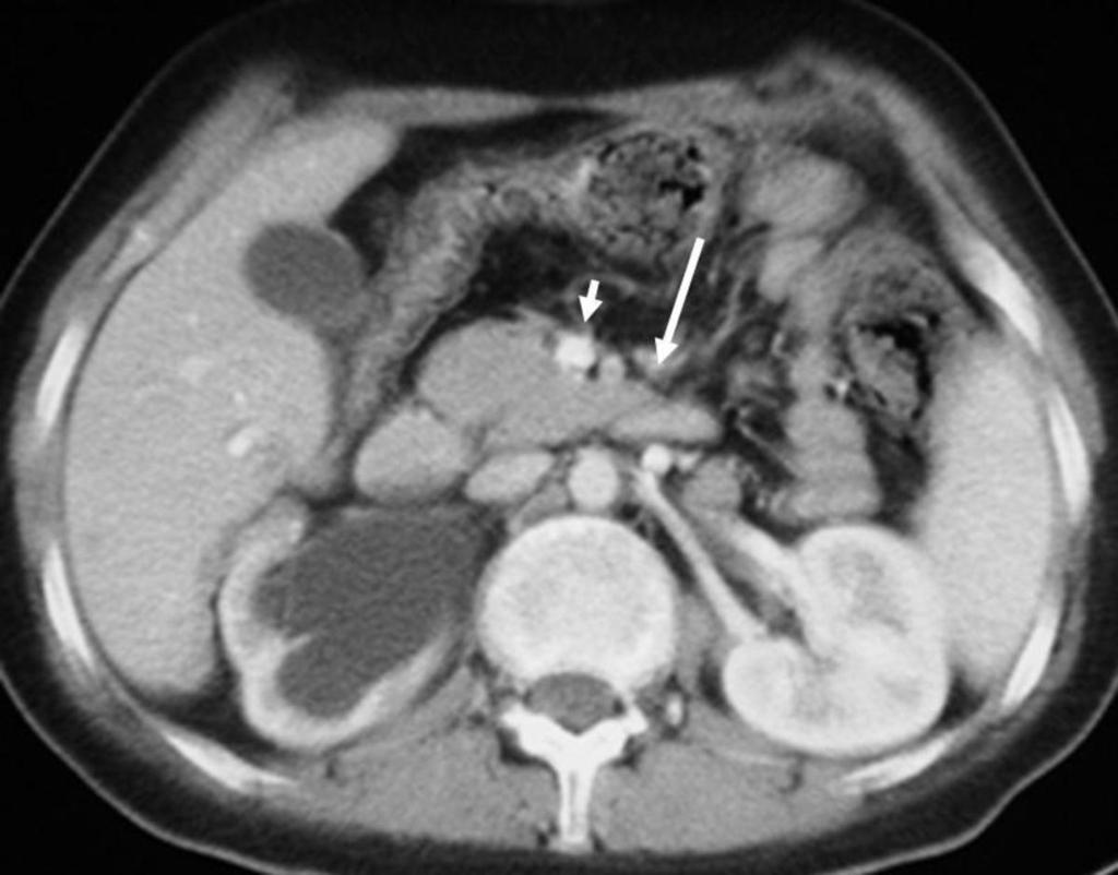 Fig. 15: SMA syndrome: CT scan of the same patient showing duodenal obstruction (long arrow) at the
