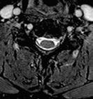 Excellent contrast axial C-spine imaging using