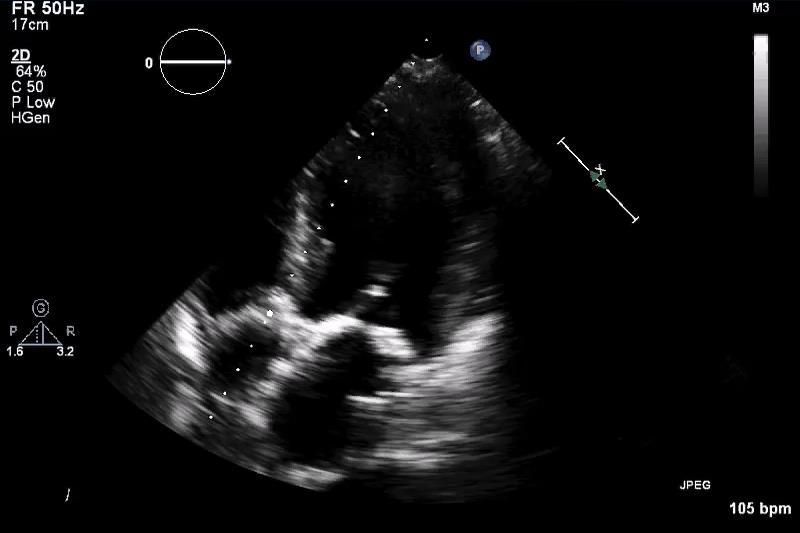 Severe Aortic Stenosis TTE Apical 5-Chamber SEVERE AORTIC STENOSIS Continuous